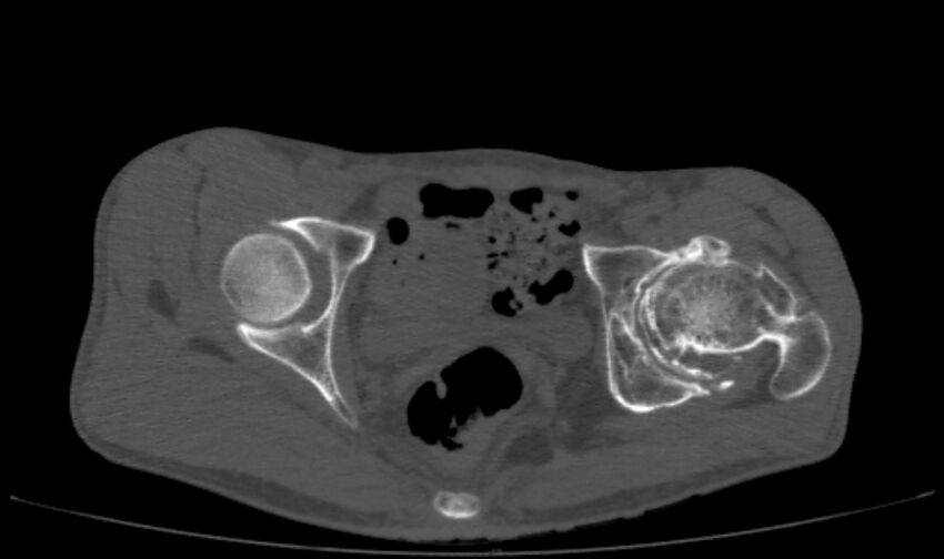 Avascular necrosis of the left hip (Radiopaedia 75068-86125 Axial bone window 46).jpg