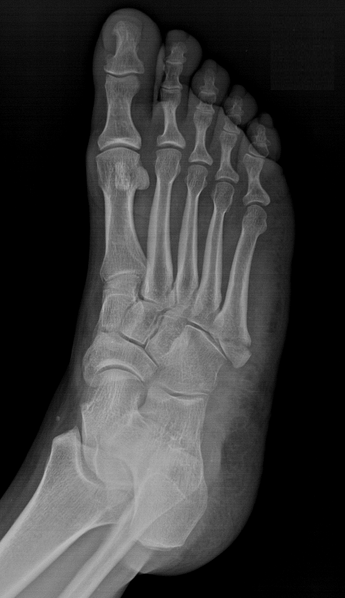 File:Avulsion fracture of the 5th metatarsal styloid (Pseudo-Jones) (Radiopaedia 33982-35199 Oblique 1).png
