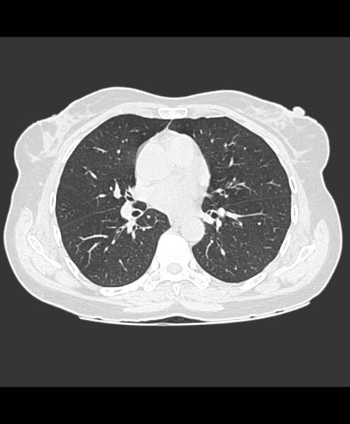 File:Azygos fissure and azygos lobe (Radiopaedia 41841-44832 Axial lung window 13).jpg