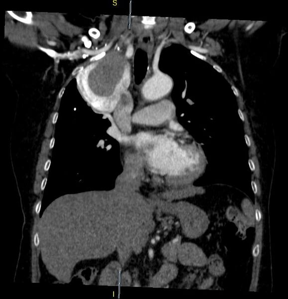 File:Azygos vein aneurysm (Radiopaedia 77824-90130 C 15).JPG