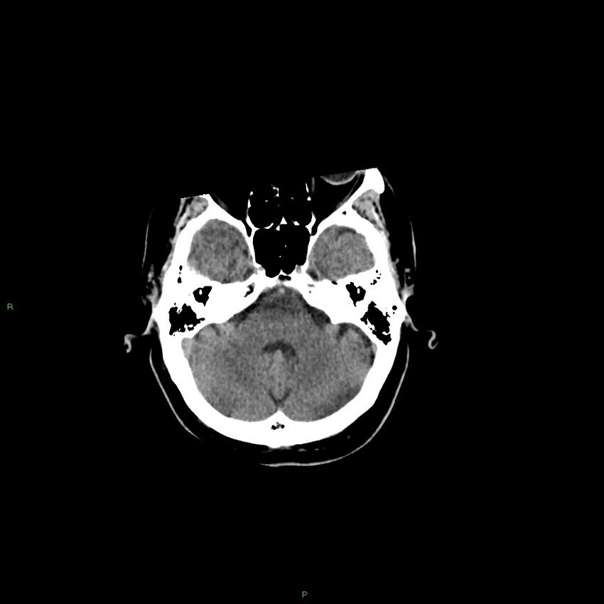 Basal ganglia hemorrhage (Radiopaedia 58346-65467 Axial non-contrast 44).jpg