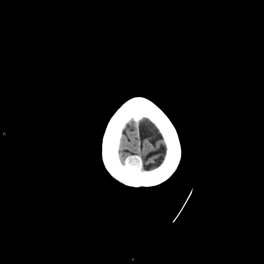 Basal ganglia hemorrhage (Radiopaedia 58350-65473 Axial non-contrast 5).jpg
