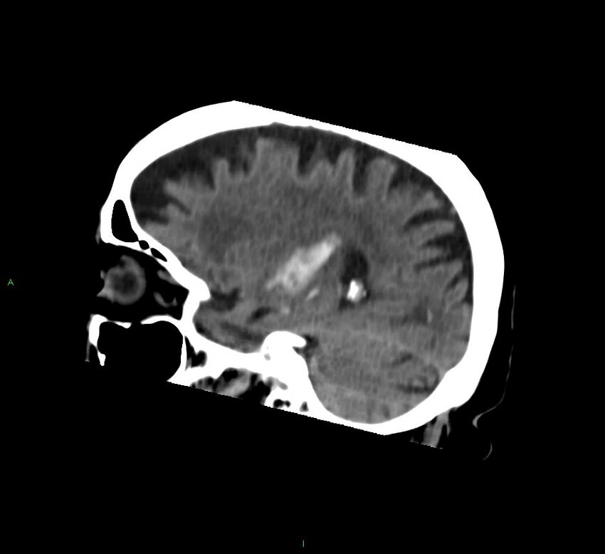 Basal ganglia hemorrhage (Radiopaedia 58762-65984 B 19).jpg
