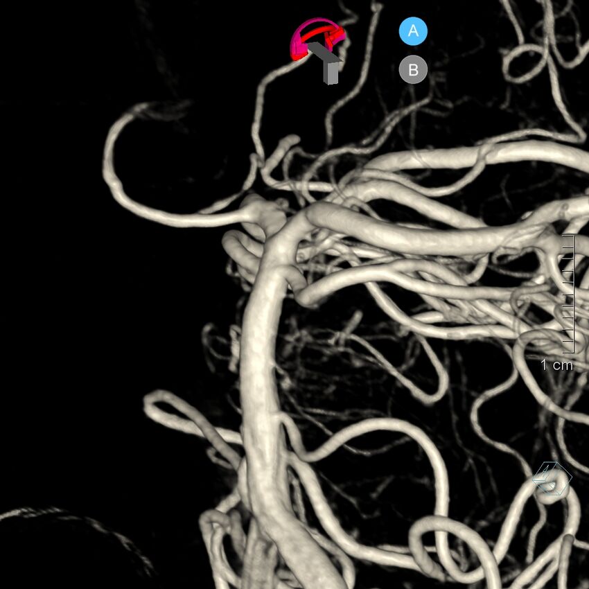 Basilar artery perforator aneurysm (Radiopaedia 82455-97734 3D view left VA 100).jpg