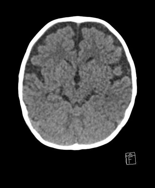 File:Benign enlargement of subarachnoid spaces in infancy (BESS) (Radiopaedia 87459-103795 Axial non-contrast 55).jpg