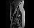 Bicornuate bicollis uterus (Radiopaedia 61626-69616 Sagittal T2 37).jpg