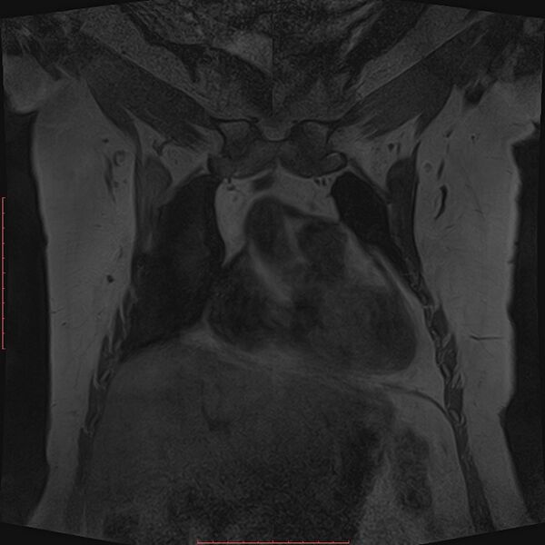 File:Bilateral breast implant rupture (Radiopaedia 24761-25027 G 8).jpg