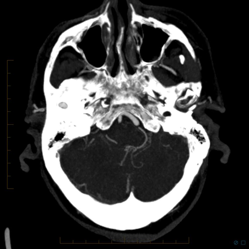 Bilateral chronic common carotid occlusion (Radiopaedia 50849-56362 D 24).jpg