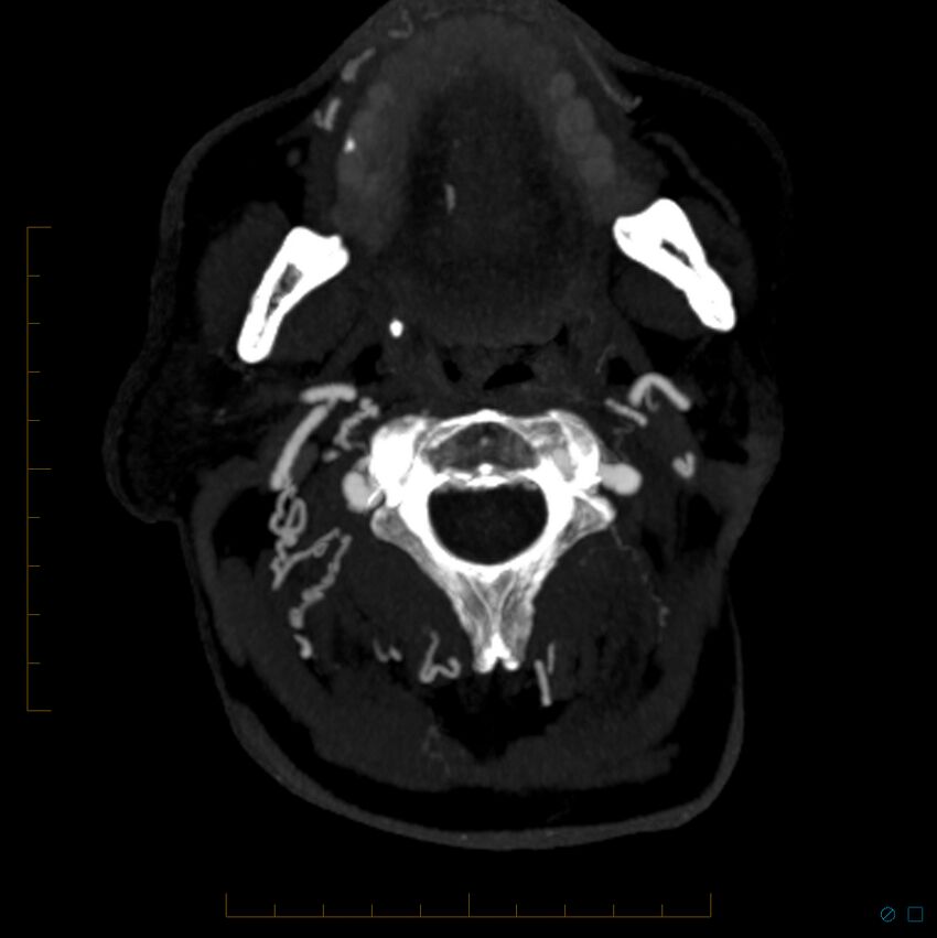 Bilateral chronic common carotid occlusion (Radiopaedia 50849-56362 D 33).jpg