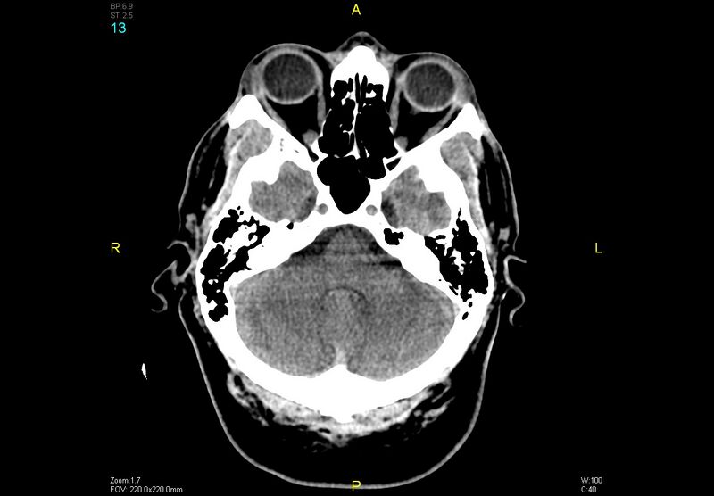 File:Bilateral medial medullary infarction (Radiopaedia 42220-45295 Axial non-contrast 13).jpg