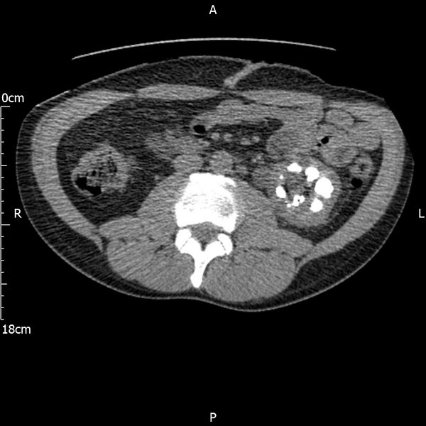 File:Bilateral medullary nephrocalcinosis with ureteric calculi (Radiopaedia 71269-81569 Axial non-contrast 59).jpg
