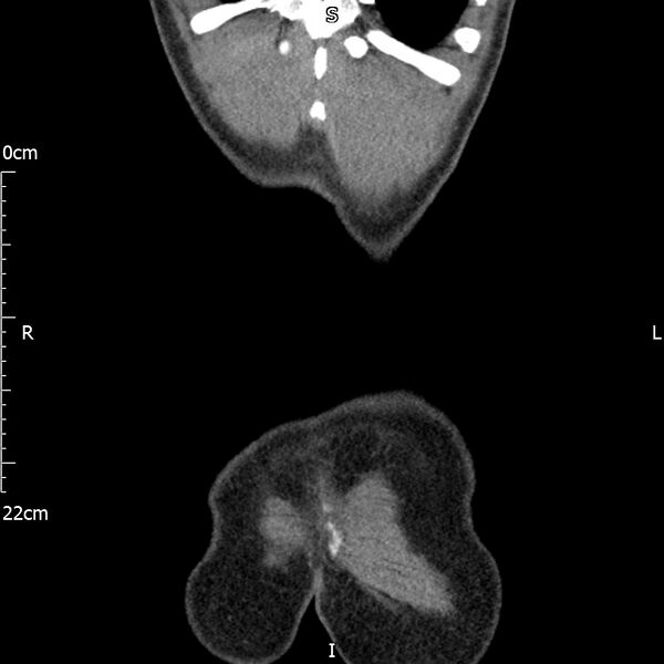 File:Bilateral medullary nephrocalcinosis with ureteric calculi (Radiopaedia 71269-81569 Coronal non-contrast 73).jpg