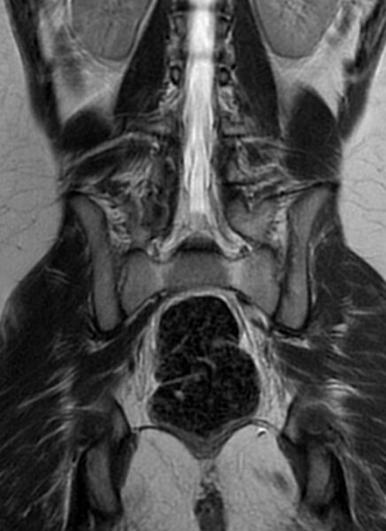 File:Bilateral ovarian fibrothecomas - adolescent (Radiopaedia 86604-102707 Coronal T2 25).jpg