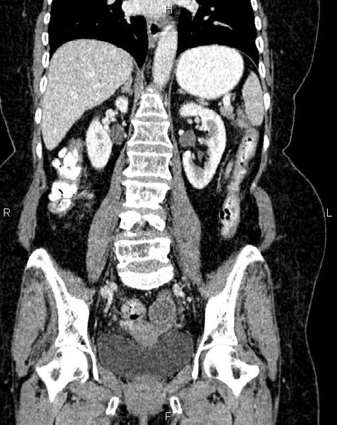 File:Bilateral ovarian serous cystadenocarcinoma (Radiopaedia 86062-101989 D 30).jpg