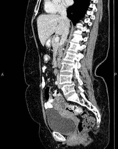 File:Bilateral ovarian serous cystadenocarcinoma (Radiopaedia 86062-101989 E 38).jpg