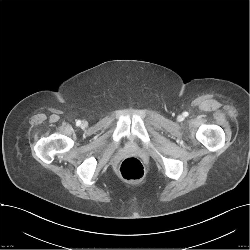 Bilateral psoas hematomas (Radiopaedia 24057-24279 A 90).jpg