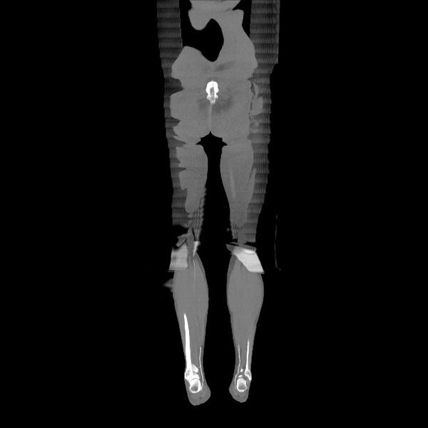 File:Bilateral superficial femoral arterial occlusion (Radiopaedia 25682-25857 Coronal MIP 25).jpg