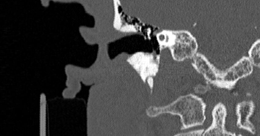 Bilateral temporal bone fractures (Radiopaedia 29482-29970 Coronal non-contrast 94).jpg