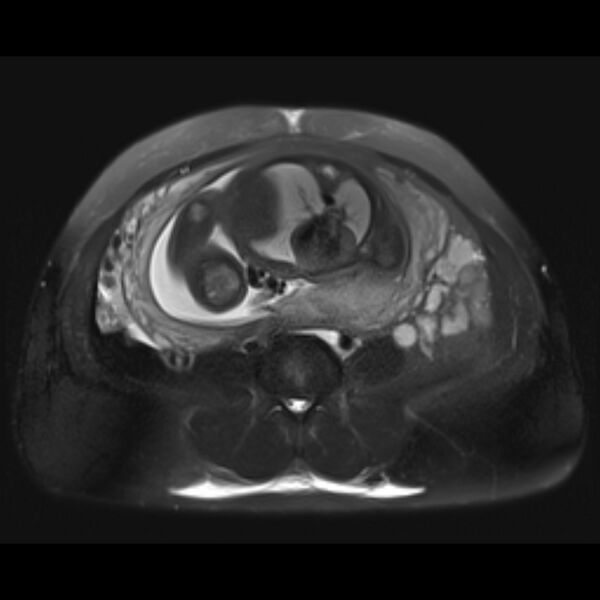 File:Bilobed placenta accreta (Radiopaedia 69648-79591 Axial T2 fat sat 24).jpg