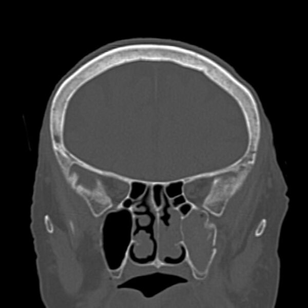 File:Biparietal osteodystrophy (Radiopaedia 46109-50463 Coronal bone window 36).jpg