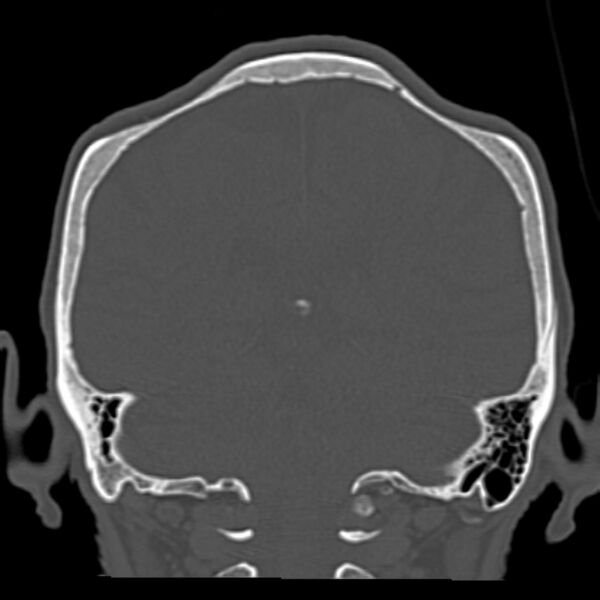 File:Biparietal osteodystrophy (Radiopaedia 46109-50463 Coronal bone window 71).jpg