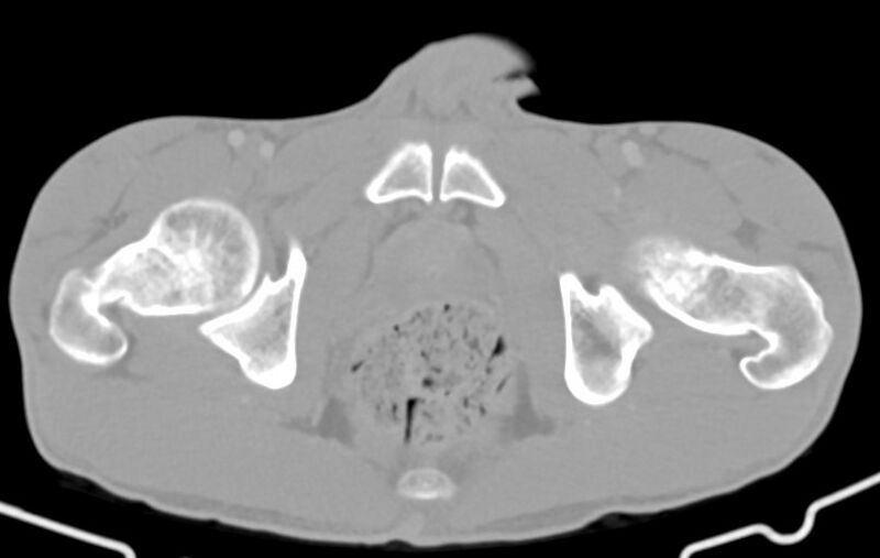 File:Blunt injury to the small bowel (Radiopaedia 74953-85987 Axial Wide 97).jpg