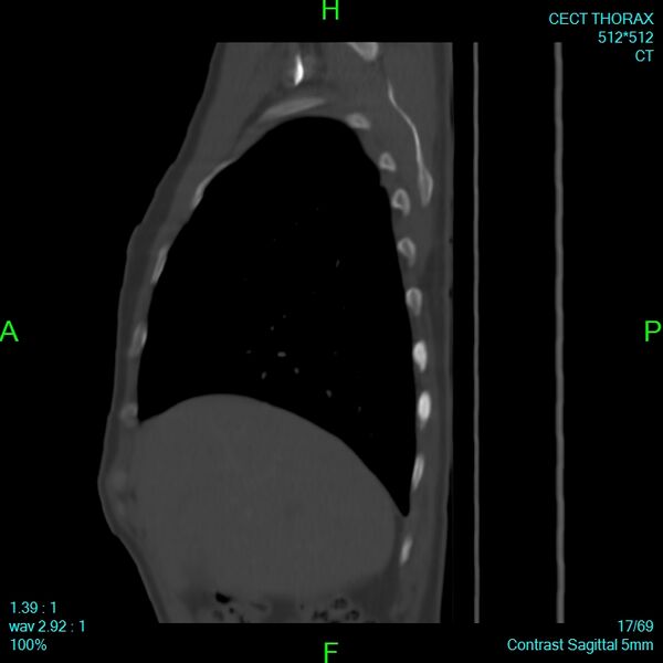 File:Bone metastases from lung carcinoma (Radiopaedia 54703-60937 Sagittal bone window 17).jpg