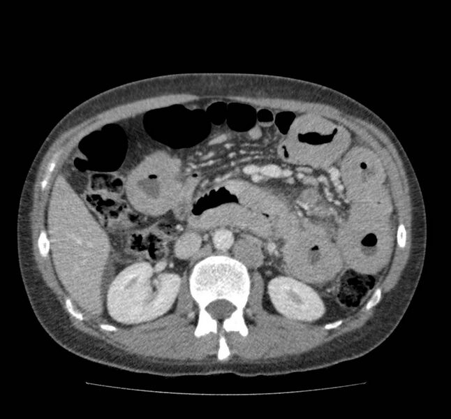File:Bowel lymphoma complicated by bleeding after therapy (Radiopaedia 55601-62107 A 35).jpg