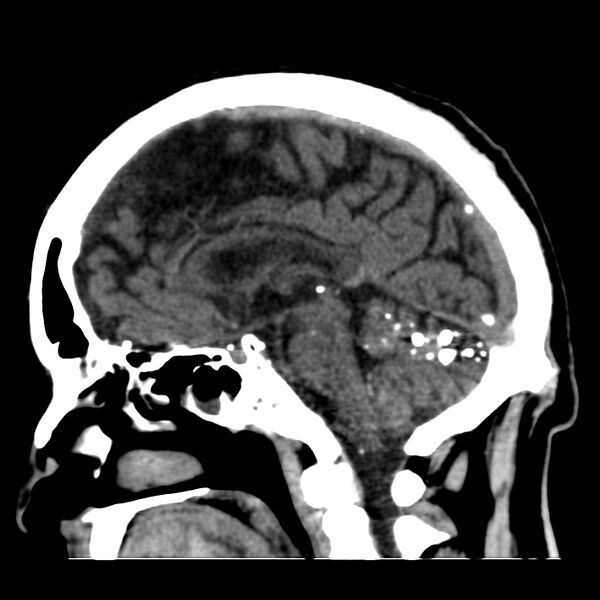 File:Brain Pantopaque remnants (Radiopaedia 78403-91048 C 28).jpg