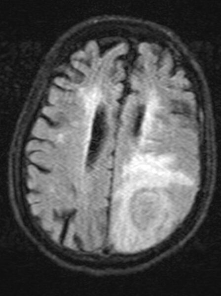 File:Brain abscess with dual rim sign (Radiopaedia 87566-103938 Axial FLAIR 16).jpg