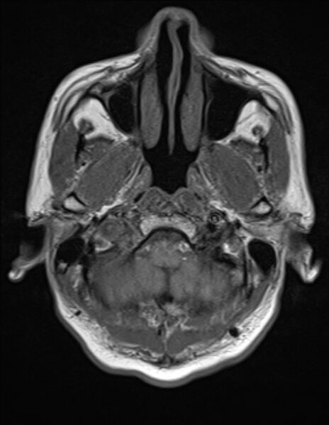 File:Brain abscess with ventriculitis (Radiopaedia 85703-101495 Axial T1 2).jpg