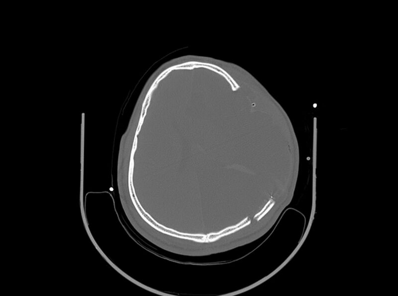 File:Brain injury by firearm projectile (Radiopaedia 82068-96087 A 125).jpg