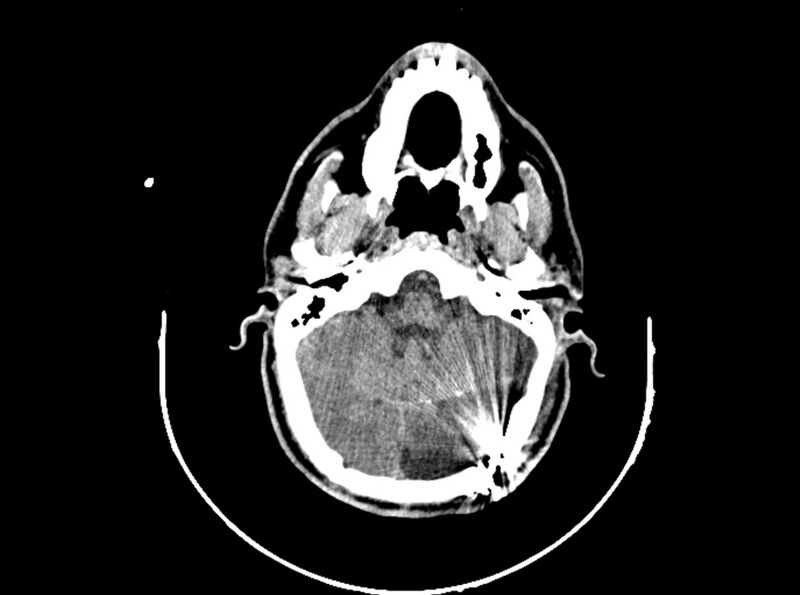 File:Brain injury by firearm projectile (Radiopaedia 82068-96088 A 84).jpg