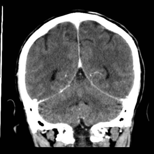 File:Brain metastases from lung cancer (Radiopaedia 24480-24781 Coronal C+ delayed 45).jpg