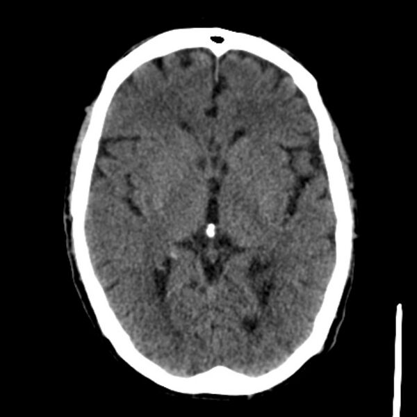 File:Brain metastases from lung cancer (Radiopaedia 27849-28092 Axial non-contrast 23).jpg