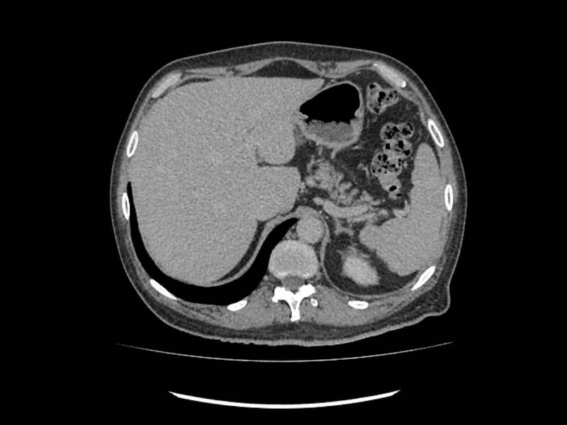 File:Brain metastases from renal cell carcinoma (Radiopaedia 42222-45328 Axial C+ delayed 2).jpg