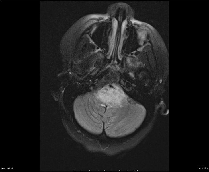 File:Brainstem glioma (Radiopaedia 21819-21775 Axial FLAIR 8).jpg