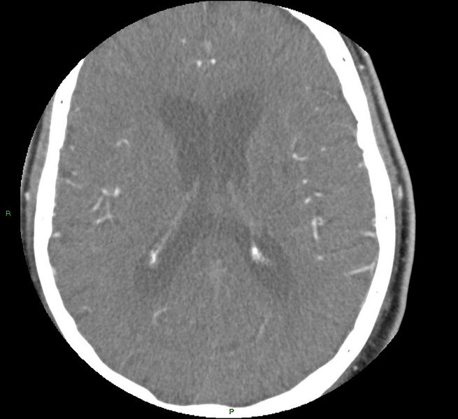 File:Brainstem hemorrhage (Radiopaedia 58794-66028 D 112).jpg