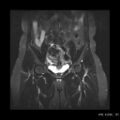 Broad ligament fibroid (Radiopaedia 49135-54241 Coronal STIR 11).jpg