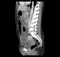 Broad ligament hernia (Radiopaedia 63260-71832 C 29).jpg