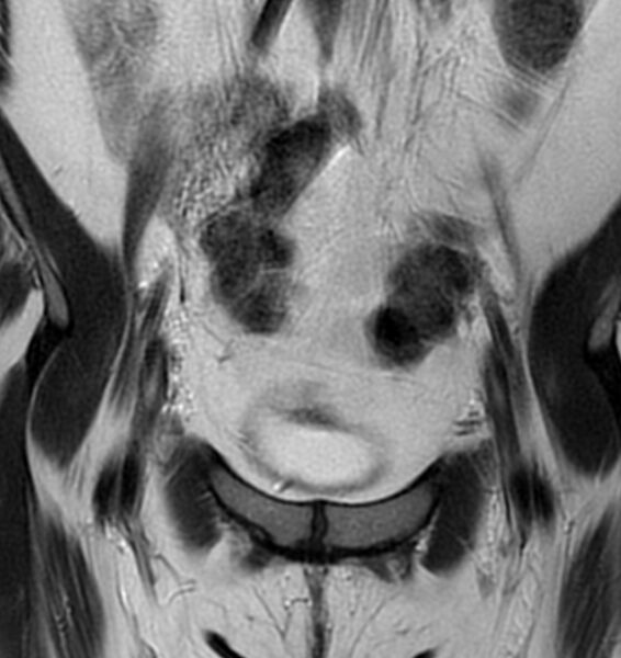 File:Broad ligament leiomyoma (Radiopaedia 81634-95516 Coronal T2 4).jpg