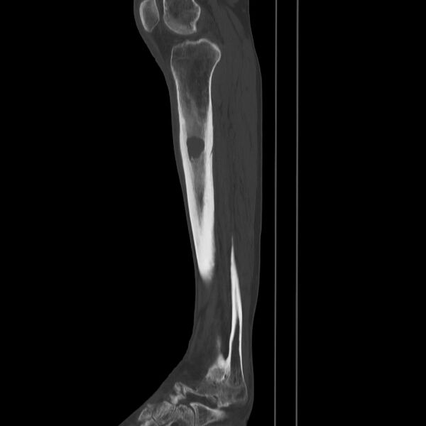 File:Brodie abscess - tibia (Radiopaedia 66028-75204 Sagittal bone window 41).jpg