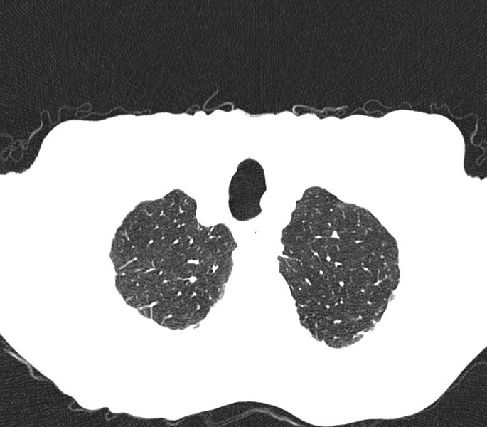 File:Bronchiolitis (Radiopaedia 24616-24887 Axial lung window 2).jpg