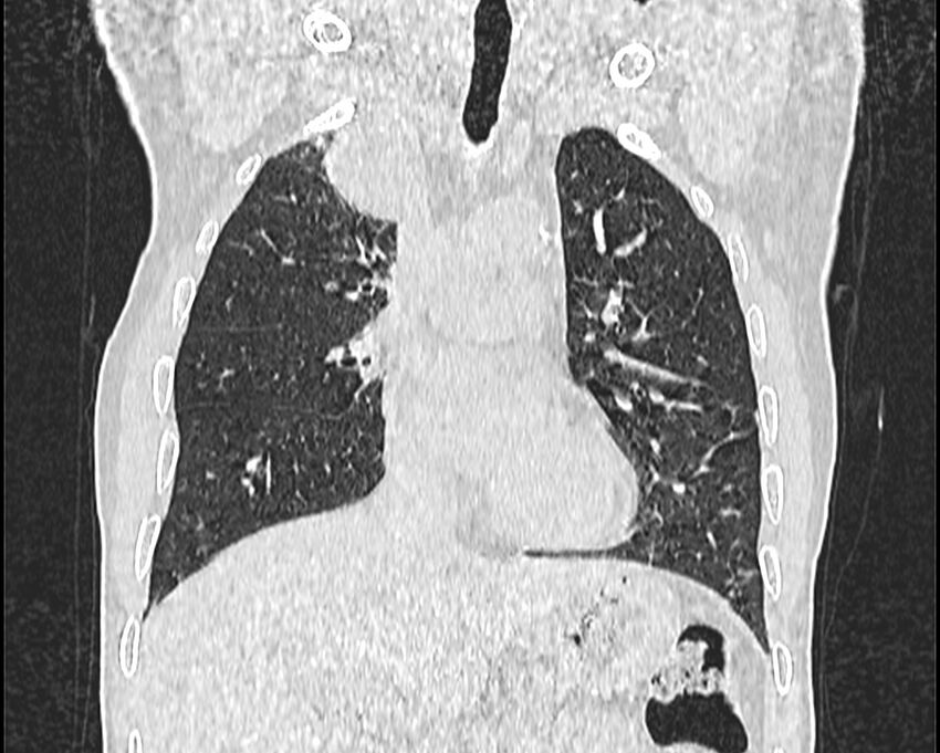 Bronchogenic carcinoma with superior vena cava syndrome (Radiopaedia 36497-38054 Coronal lung window 21).jpg