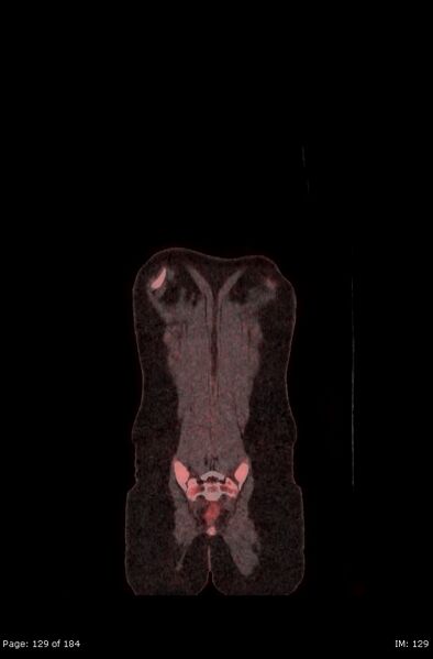 File:Brown fat uptake (FDG PET-CT) (Radiopaedia 77392-89513 Fused coronal 87).jpg