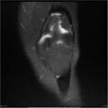 Bucket handle tear - lateral meniscus (Radiopaedia 7246-8187 Coronal T2 fat sat 18).jpg