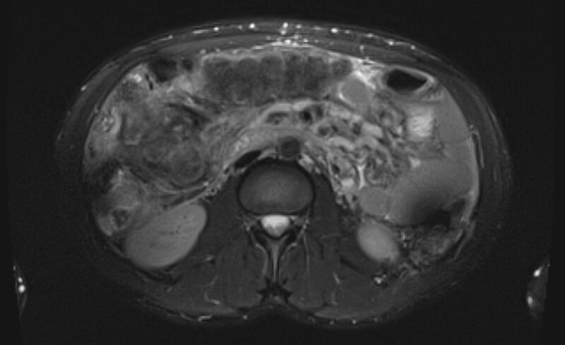 File:Budd Chiari syndrome (Radiopaedia 70299-80375 Axial T2 fat sat 29).jpg