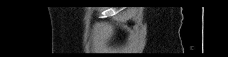 File:Buried bumper syndrome - gastrostomy tube (Radiopaedia 63843-72575 Sagittal Inject 115).jpg