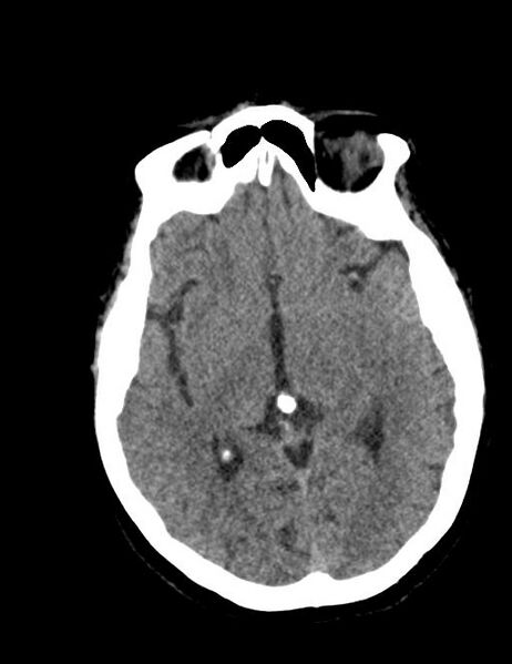 File:Burnt-out meningioma (Radiopaedia 51557-57337 Axial non-contrast 20).jpg