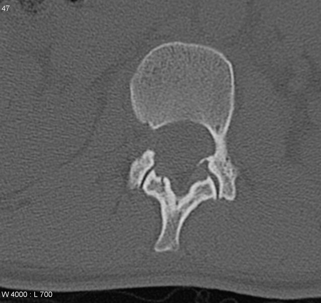 File:Burst fracture (Radiopaedia 5274-7018 Axial bone window 11).jpg